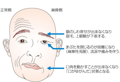 麻痺 ベル